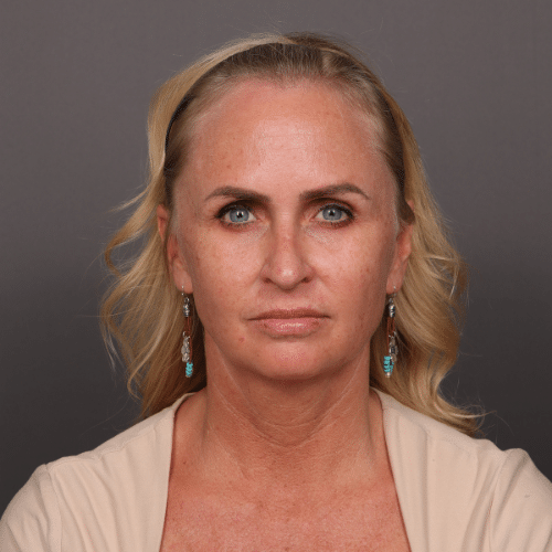 Before Image: Facelift & Chin Implant - front
