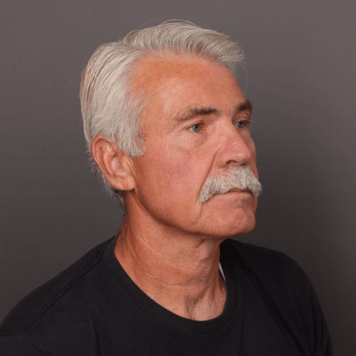 After Image: Brow Lift by Dr. Henstrom - 