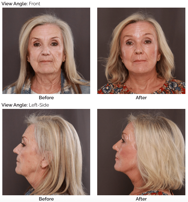Facelift Utah Facial Plastics