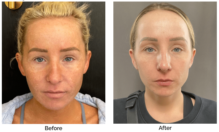 Collagen Induction Therapy, Moxi, & BBL Collagen Induction Therapy, Moxi, & BBL