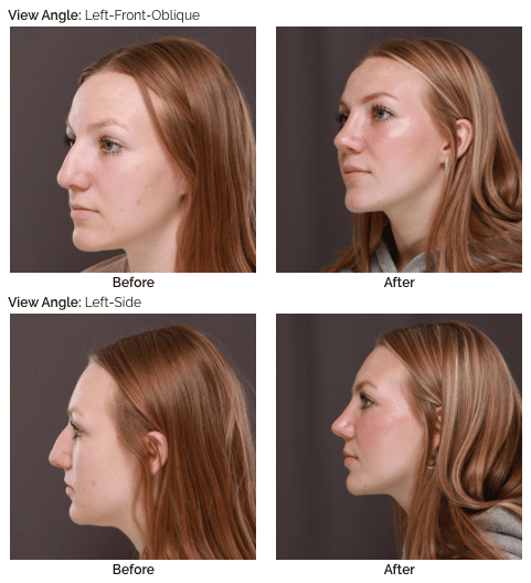 Rhinoplasty UFP