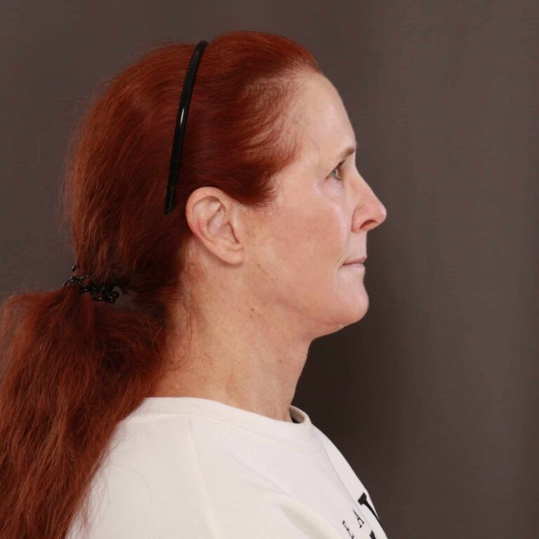 After Image: Facelift & Upper Blepharoplasty with Contour TRL - right-side