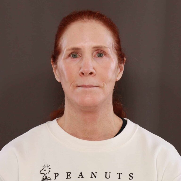 After Image: Facelift & Upper Blepharoplasty with Contour TRL - front