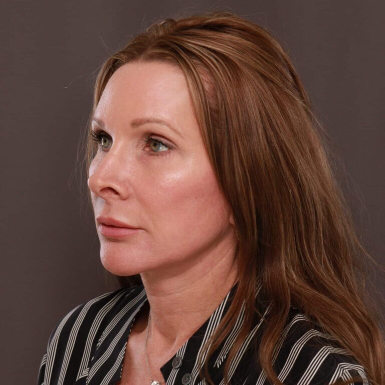 After Image: Facelift, Browlift, Lower Blepharoplasty & Contour TRL - left-front-oblique