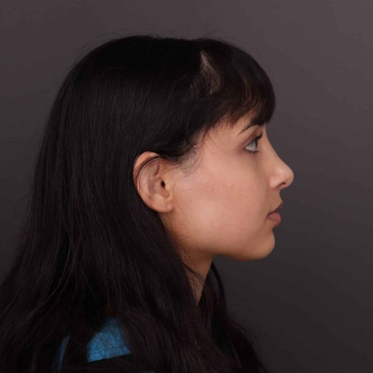 After Image: Rhinoplasty - 