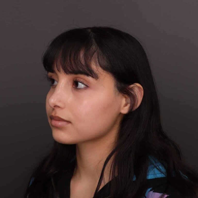 After Image: Rhinoplasty - 