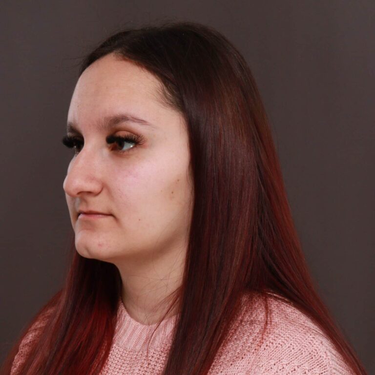 Before Image: Rhinoplasty with Weirs - left-front-oblique