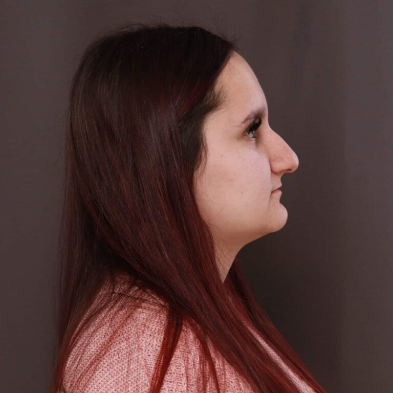 Before Image: Rhinoplasty with Weirs - right-side