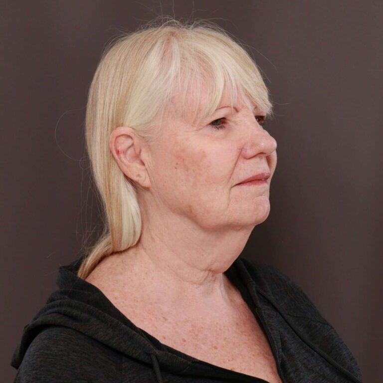 Before Image: Direct Necklift - right-front-oblique