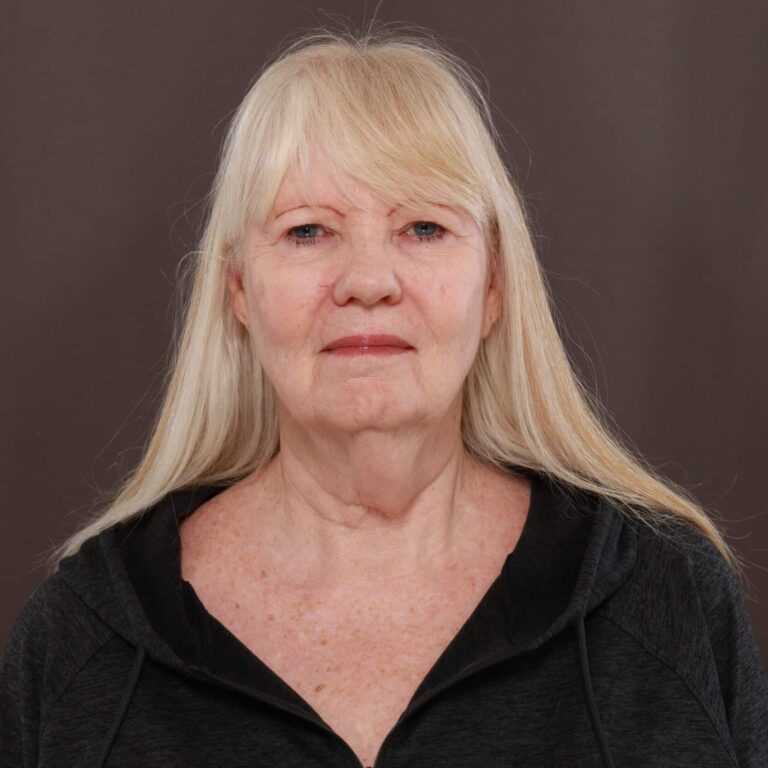Before Image: Direct Necklift - front