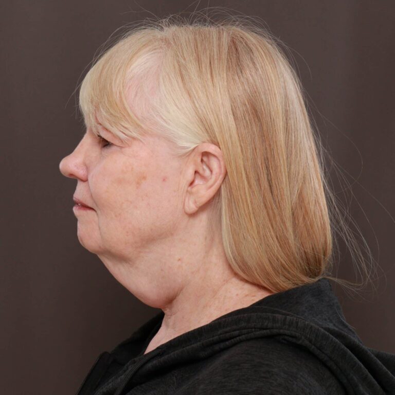 Before Image: Direct Necklift - 