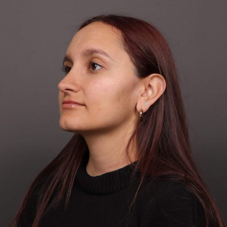 After Image: Rhinoplasty with Weirs - left-front-oblique