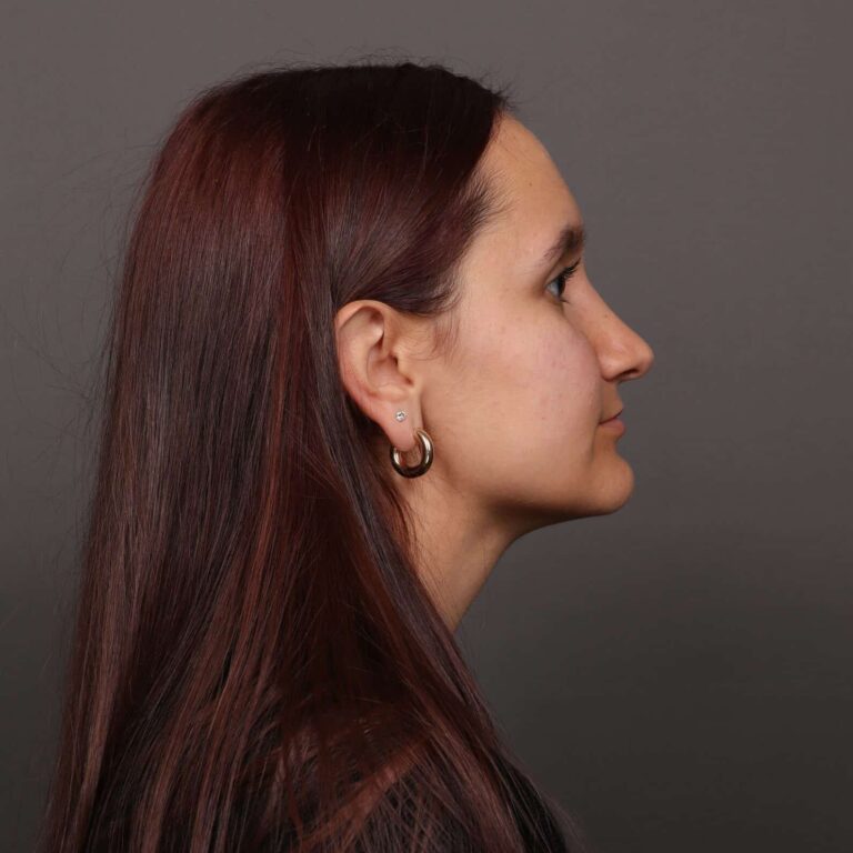 After Image: Rhinoplasty with Weirs - right-side