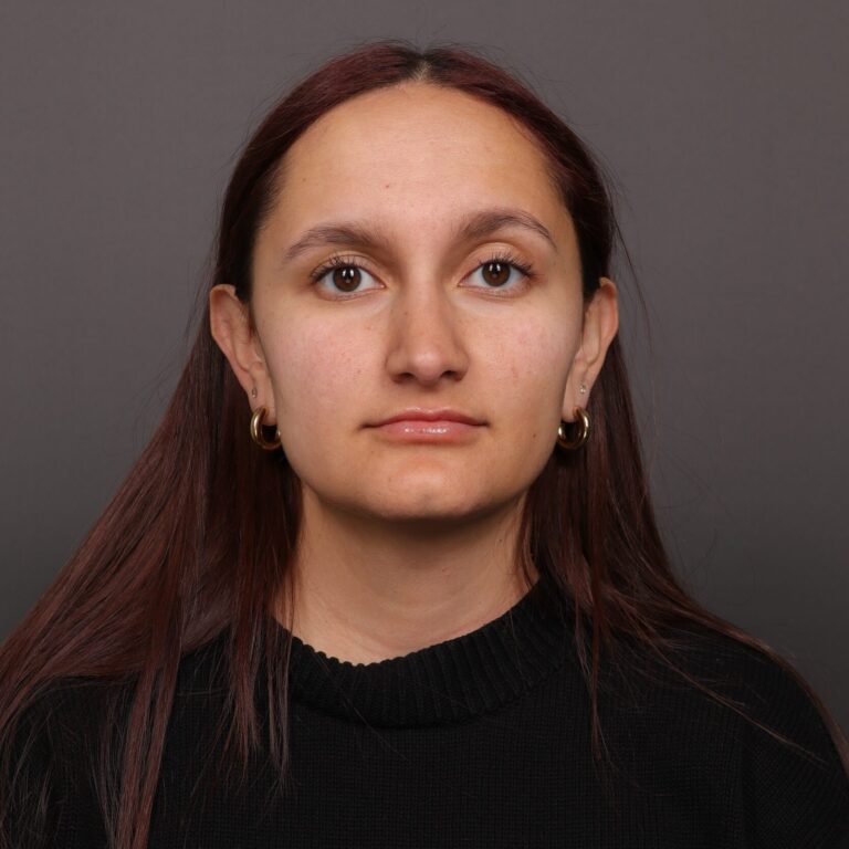After Image: Rhinoplasty with Weirs - front