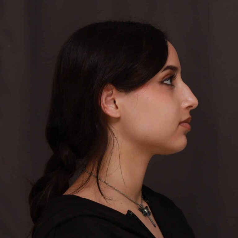 Before Image: Rhinoplasty - 