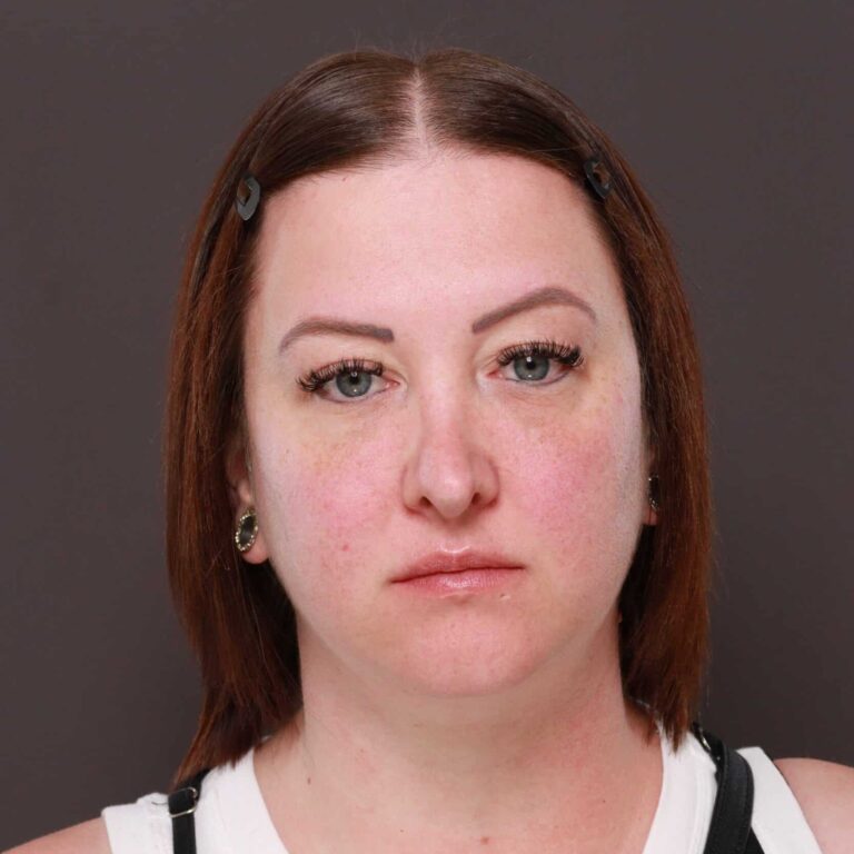 Before Image: Revision Rhinoplasty - front