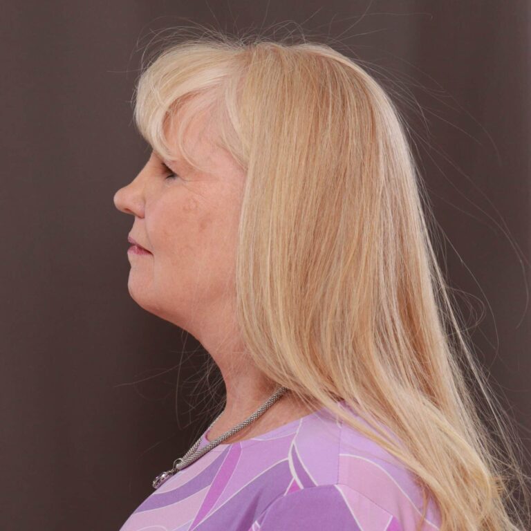 After Image: Direct Necklift - 