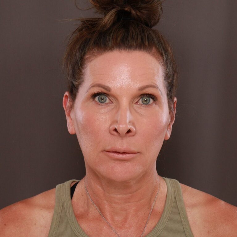 Before Image: Facelift, Browlift, Lower Blepharoplasty & Contour TRL - front