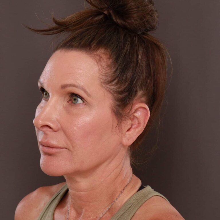 Before Image: Facelift, Browlift, Lower Blepharoplasty & Contour TRL - left-front-oblique