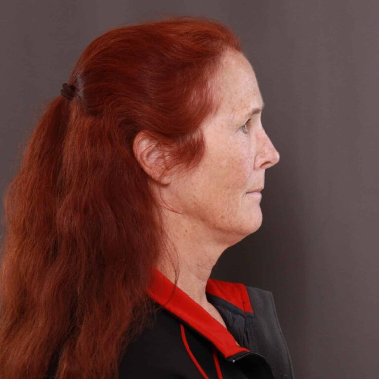 Before Image: Facelift & Upper Blepharoplasty with Contour TRL - right-side