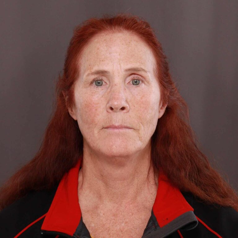 Before Image: Facelift & Upper Blepharoplasty with Contour TRL - front