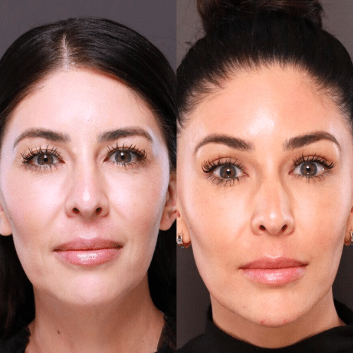 Utah Facial Plastics Dermal Fillers Utah Facial Plastics Dermal Fillers
