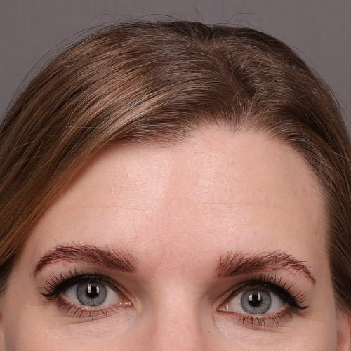 After Image: Eyebrow Transplant - front