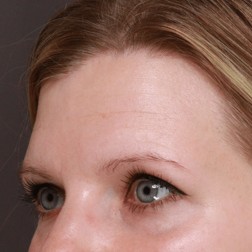 Before Image: Eyebrow Transplant - front