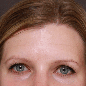 Before Image: Eyebrow Transplant