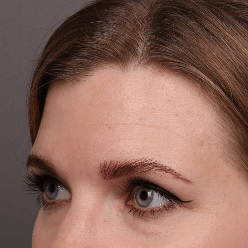 After Image: Eyebrow Transplant - front