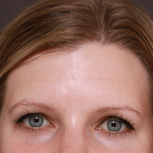 Before Image: Eyebrow Transplant - front