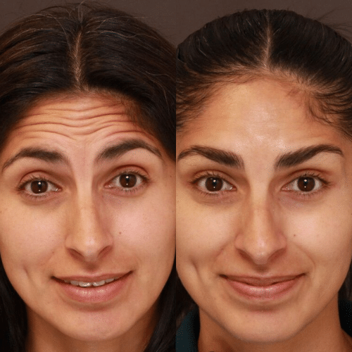 Botox Treatments Botox Treatments