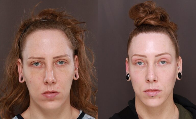 Brow lift or Forehead lift at Utah Facial Plastics Brow lift or Forehead lift at Utah Facial Plastics