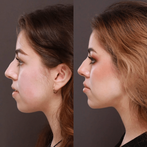 Dermal Filler Before & After Dermal Filler Before & After