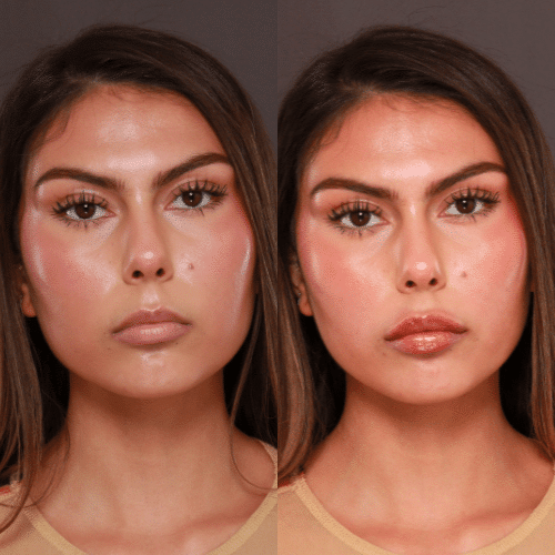 Dermal Fillers Before & Afters