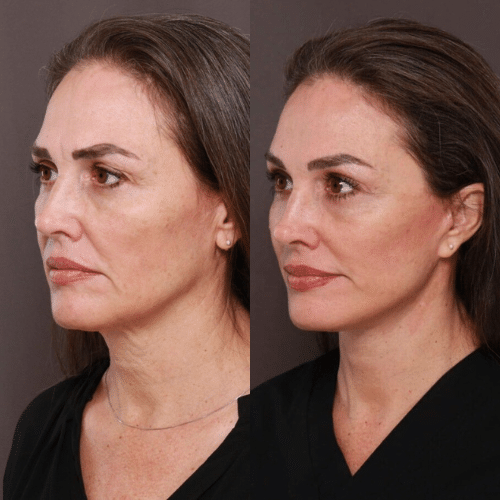 Facelift Before & After (2) Facelift Before & After (2)