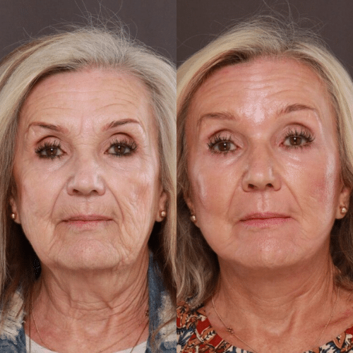 Facelift Before & After (3) Facelift Before & After (3)