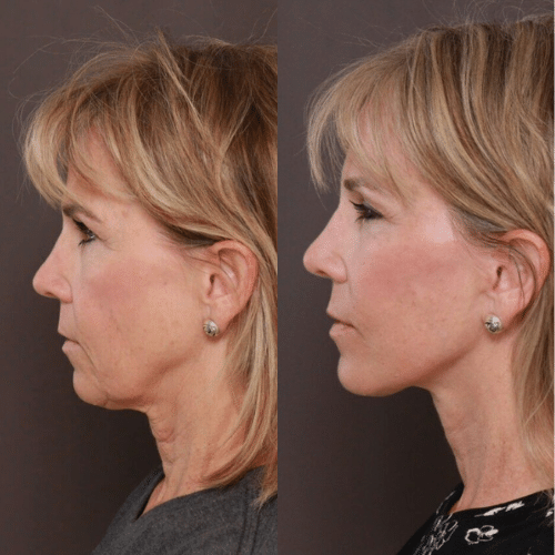 Facelift Before & After (4) Facelift Before & After (4)