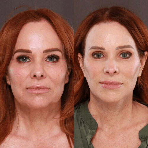 Facelift Before & After Facelift Before & After