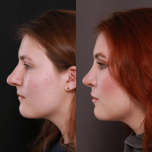 Rhinoplasty Before & After Rhinoplasty Before & After