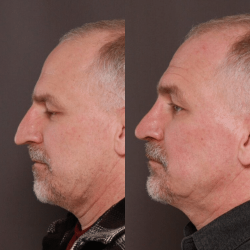 Rhinoplasty Before & After (3) Rhinoplasty Before & After (3)