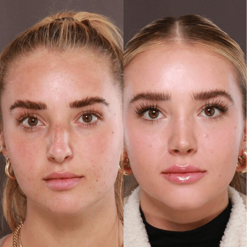 Rhinoplasty Before & After (4) Rhinoplasty Before & After (4)