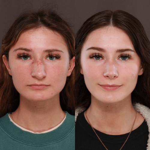 Rhinoplasty Before & After Rhinoplasty Before & After