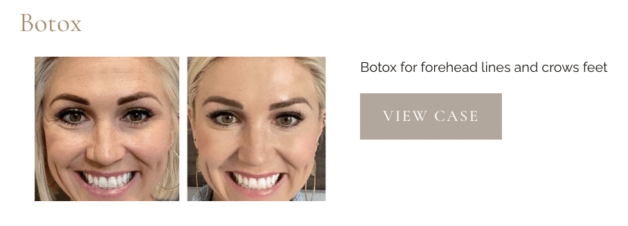Botox for crows feet at utah facial plastics
