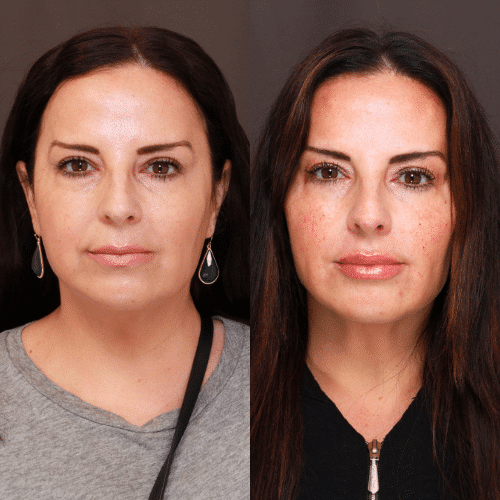 Utah Facial Plastics Dermal Fillers Utah Facial Plastics Dermal Fillers