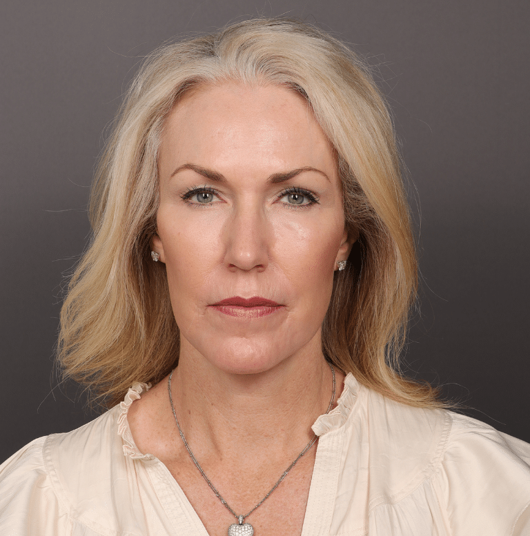 Utah Facial Plastics Facelift (2)