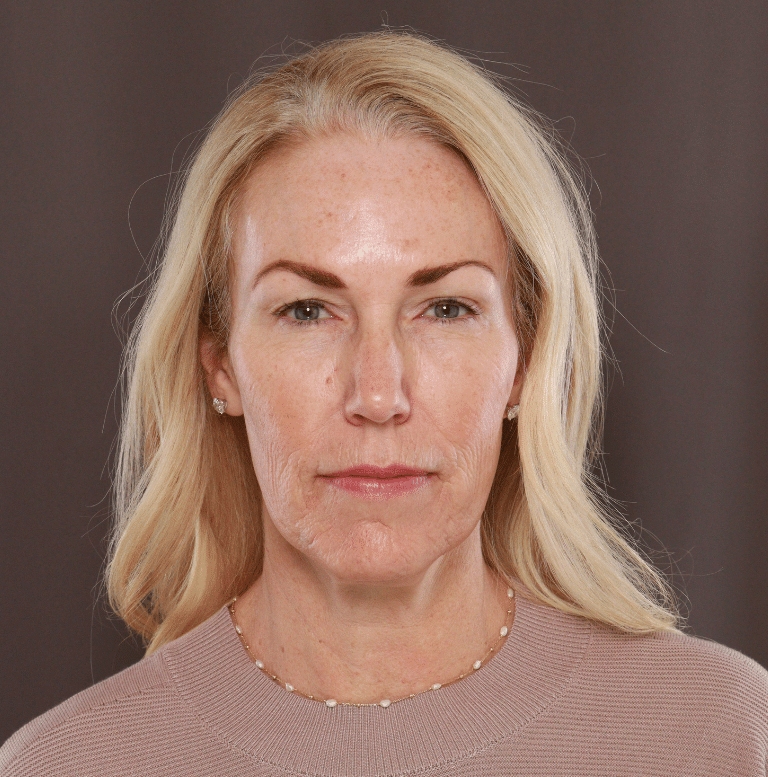 Utah Facial Plastics Facelift