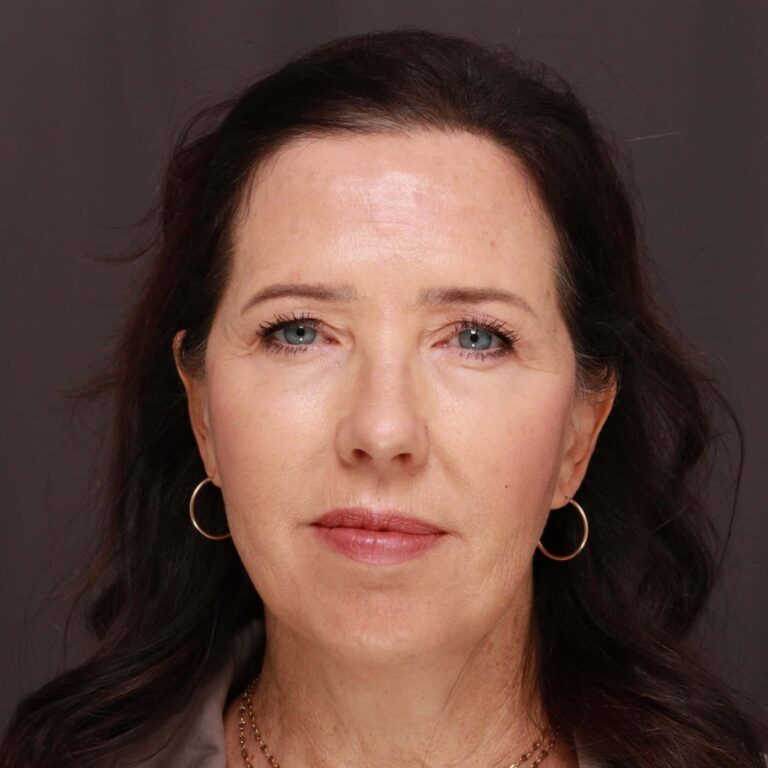 Before Image: Facelift, Browlift, Upper & Lower Blepharoplasty, Chin Implant & Fat Graft - front