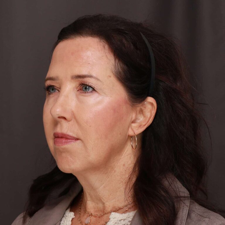 Before Image: Facelift, Browlift, Upper & Lower Blepharoplasty, Chin Implant & Fat Graft - 