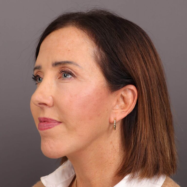 After Image: Facelift, Browlift, Upper & Lower Blepharoplasty, Chin Implant & Fat Graft - 